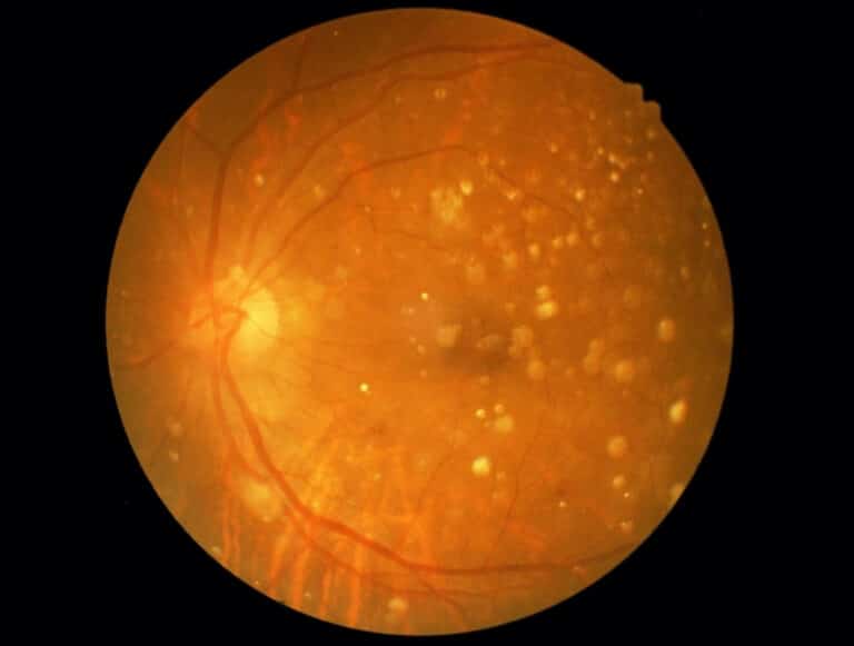 Macular Degeneration Alaska Retinal Consultants