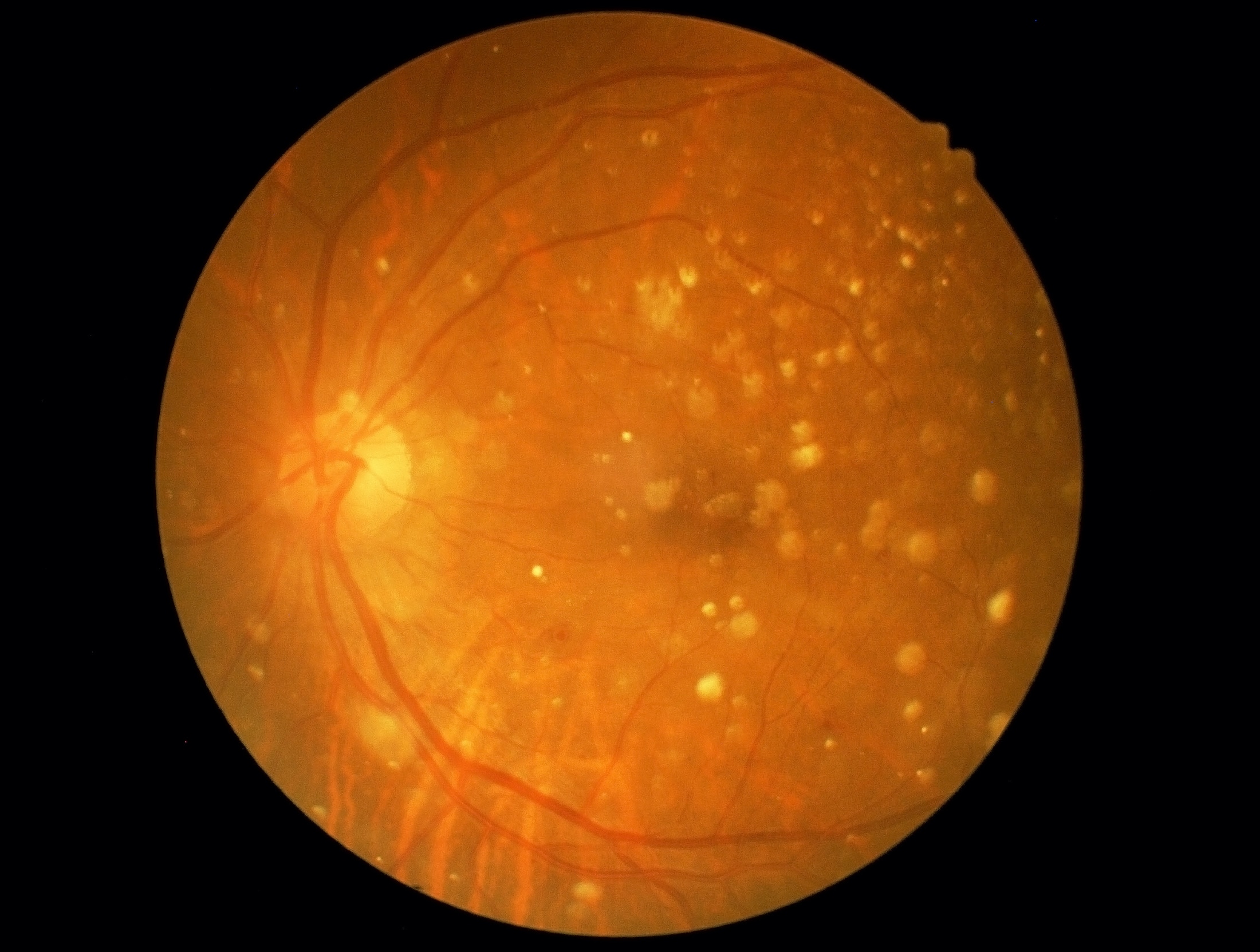 Macular Degeneration Alaska Retinal Consultants