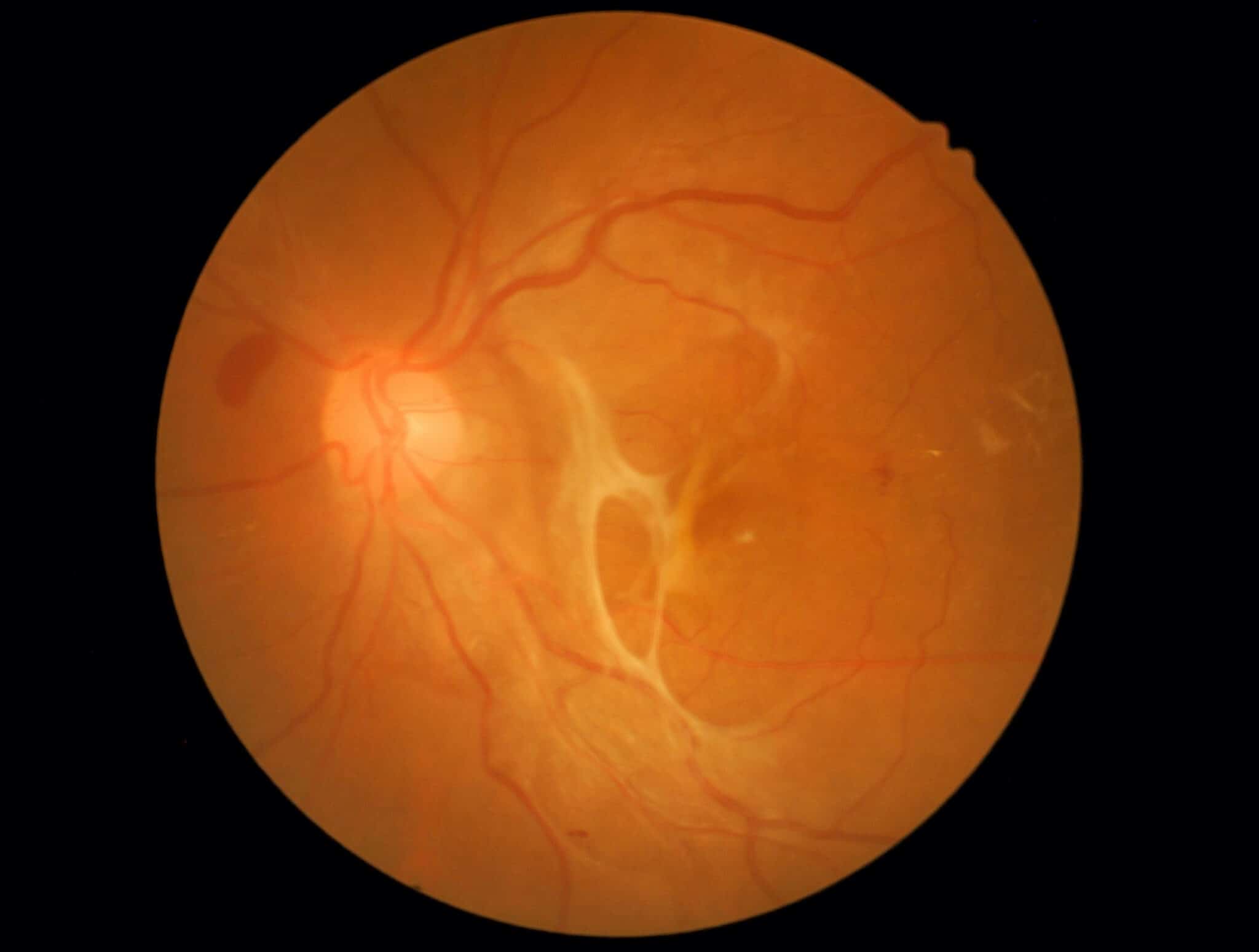 Retinal Detachment Alaska Retinal Consultants